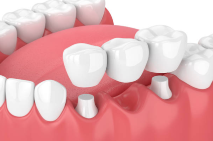 Bridge dentaire prix : Quelles options pour un sourire parfait sans se ruiner ?